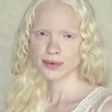 Resultado de imagem para pessoas albinas