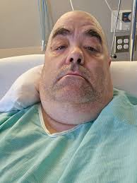 DONE HAD A "GEP TUBE" BUT IN Is a short, simplified term for a Percutaneous  Endoscopic Gastrostomy (PEG) tube. It's a type of feeding tube inserted  through the abdominal wall into the