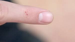 Image result for bedbugs bites