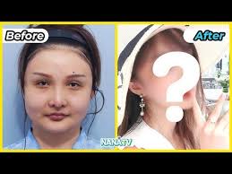 Pin By Alissa Gomez On Plastic Surgery Plastic Surgery Plastic Surgery Korea Liposuction