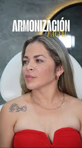 Armonización facial con 8 ML de ácido hialuronico 💉✨, #fillers  #armonizacionfacial #acidohialuronico