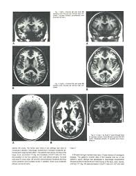 Http Www Ajnr Org Content Ajnr 7 1 25 Full Pdf