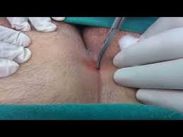 You may also be able to visualize hair within the luckily, ingrown hairs typically resolve on their own, but if you simply can't resist speeding up the process, here are a few. Bunches Of Hair In Pilonidal Sinus Removal Thereof Youtube