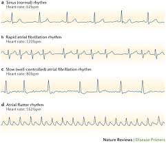 Image result for Atrial Fibrillation