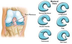 Meniscus tears can happen during a rotating movement while bearing weight, such as when twisting the upper leg while the foot these symptoms may look like other health conditions or problems. Physical Therapy To Treat Torn Meniscus Comparable To Surgery For Many Patients Niams