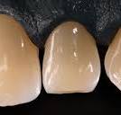 Ultra Translucent FZ - Advanced Dental Technologies