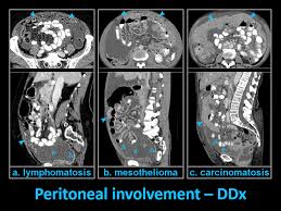 To confirm a peritoneal mesothelioma diagnosis, doctors will likely order a diagnostic procedure called a peritoneoscopy. Epos Trade