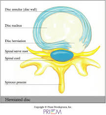 Trust your recovery to the experts! University Orthopedics Herniated Disc Providence Rhode Island