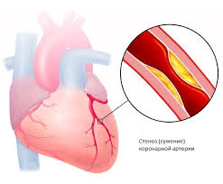 Image result for Angina Pectoris