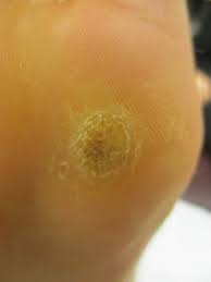 I went to the podiatrist, he said it was a wart when the whole time we thought it. Office Surgical Procedures Plantar Warts Verrucae Act Podiatry