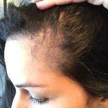 This company went out of business several years ago due to complaints that their products caused or contributed to hair loss. Celebrity Shampoo Sold In Sa Sued For Causing Hair Loss In Women Health24