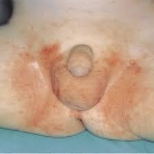 Image result for dermatitis contacta allergica