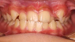 How To Fix One Crooked Tooth Without Braces
