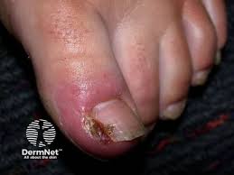 Image result for Paronychia feet