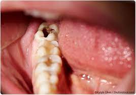 Treatment And Prevention Of Tooth Decay