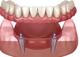 Image result for dentures