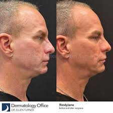 ✨ Before & After: Restylane Transformation! ✨ See the impressive results of  Restylane treatment