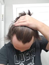 It's important not to panic if you notice that your hairline is receding. How Bad Is This Hairline I M A Male Of Seventeen Just Lay It On Me And Don T Sugarcoat It Is Thi Bad Hairline Thin Hair Men Hairstyles For Receding Hairline