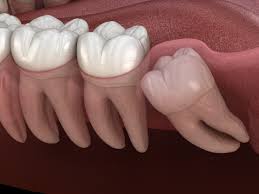 Does medicare cover impacted wisdom teeth? Are Your Wisdom Teeth Keeping You Awake At Night Oral Maxillofacial Associates