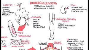 atherosclerosis pathophysiology