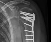 Example of proximal humerus fracture, managed by angle ...
