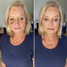 Makeup coverage for post-injury and surgery