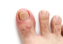 how to get rid of an ingrown toenail