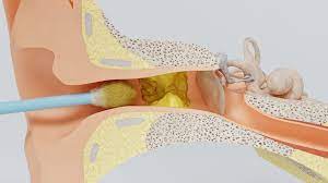 Donc pour se débarrasser des boutons dans les oreilles ce problème est commun aux personnes qui ont beaucoup de poils de l'oreille ainsi que celles qui ne savent pas comment retirer les cheveux de leurs. Coton Tige Dangers Alternatives Comment Se Nettoyer Les Oreilles