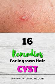 Ingrown Hair Cyst Bump Causes And Treatments Ingrown Hair Cyst Ingrown Hair Diy Ingrown Hair Treatment
