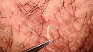 Most ingrown pubic hairs are caused by shaving or waxing the hair in the area 4. Ingrown Hair Cluster Of Ingrown Hairs On Face