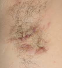 .hab ich grade entdeckt, als ich in der wanne lag. Unterschiedliche Symptome Bei Acne Inversa