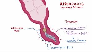 Image result for Appendicitis