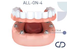 Check spelling or type a new query. Comfortable Dentures In Northern Ireland