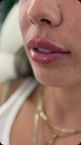 Bringing the heat to Miami. 🔥🫦 Hope your girls trip was a blast babe!  Dying over her gorgeous skin too. 💕 #Beautifullips #happylips #prettylips  #lips #lipfiller #lippop #kysse #kysselips #subtleenhancement #lessismore