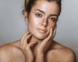 Image result for Melasma