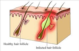 folliculitis info
