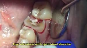 Even though children's teeth are okay to be pulled out (if they are very loose), it's recommended to keep hands out of the mouth as this can. How To Pull Your Own Tooth Methods And Risks Is It Worth It