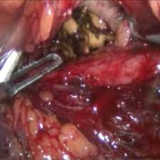 Kidney Stone Extracted By Laparoscopic Grasping Instruments Download Scientific Diagram