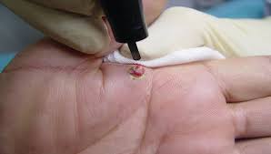 Image result for Pyogenic Granuloma