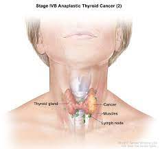 Cervical (neck) lymph node enlargement. Endocrine Surgery Thyroid Cancer
