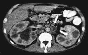 Image result for Genitourinary Tuberculosis