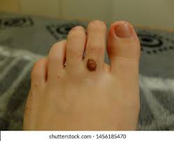 We have included some pictures below of canker sores that you can look at to determine if what you have is a canker sore. Pigmented Birthmark Mole On Toe Closeup Stock Photo Edit Now 1456185470
