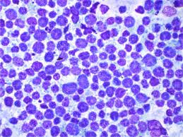 Image result for Thyroiditis