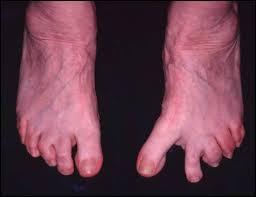 Image result for Hallux Varus