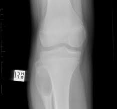 Both simple solitary bone cyst (cck) and aneurysmal have common etiopathogenetic causes, however their symptoms are different in the same way as radiographic visual indices. Aneurysmal Bone Cyst Abc Radiology Case Radiopaedia Org