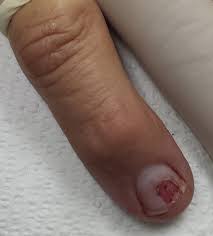 A healthy toenail is smooth, consistent in color, and generally pinkish. Subungual Lesion Hasn T Grown Out Benign Or Malignant Clinician Reviews
