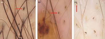 An old razor does not cut the hairs away from the skin but yanks them out, causing minimal blood loss that causes the black dots in hair follicles after. Black Dots Seen Under Trichoscopy Are Not Specific For Alopecia Areata Kowalska Oledzka 2012 Clinical And Experimental Dermatology Wiley Online Library