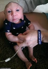 Miracle baby born with part of his brain and skull missing celebrates his  first birthday