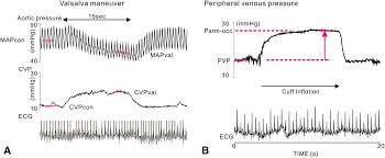 The exception is dbdatetime, which is recorded as a local time. Assessment Of Central Venous Physiology Of Fontan Circulation Using Peripheral Venous Pressure The Journal Of Thoracic And Cardiovascular Surgery