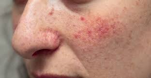 Image result for red rash face